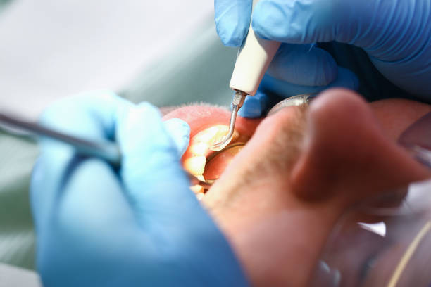 Best Emergency Dental Care for Abscessed Tooth in Saugerties South, NY